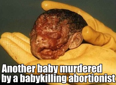 Baby killed by abortion
