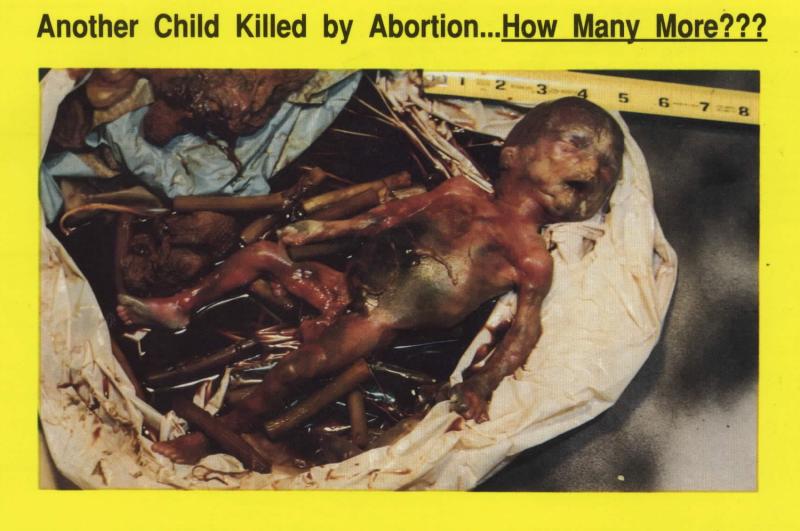 Baby murdered by abortion