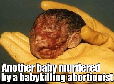 Baby killed by abortion